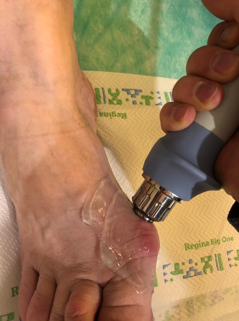 Leczenie haluksów falą uderzeniową