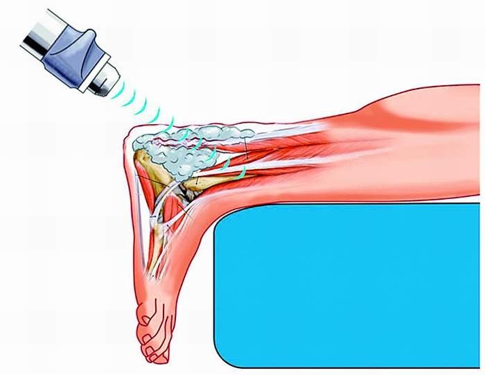 pięta haglunda leczenie warszawa