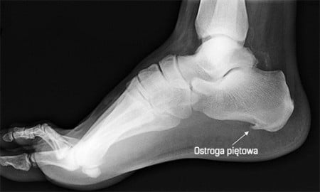 ostroga piętowa dolna
