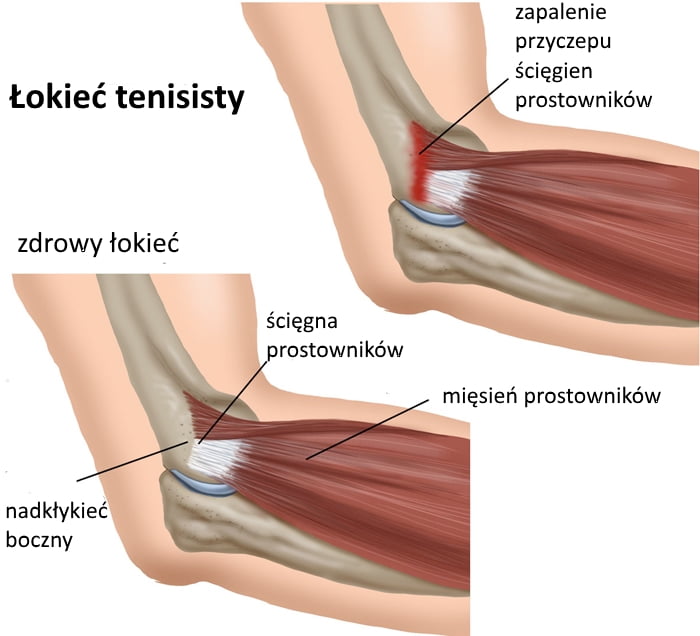 łokieć-tenisisty łokieć tenisisty leczenie